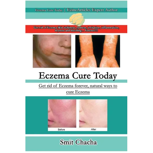 Eczema Cure Today - Get rid of Eczema forever natural ways to cure Eczema - Paperback