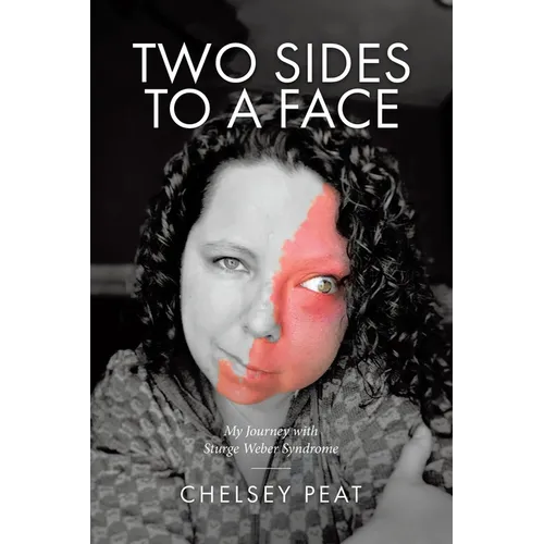 Two Sides to a Face: My Journey with Sturge Weber Syndrome - Paperback