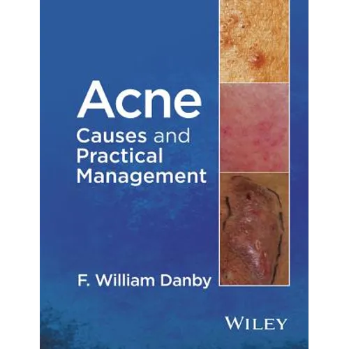 Acne: Causes and Practical Management - Hardcover