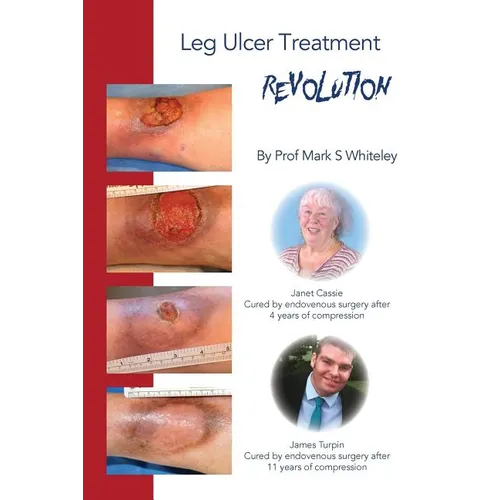 Leg Ulcer Treatment Revolution - Paperback