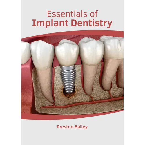 Essentials of Implant Dentistry - Hardcover
