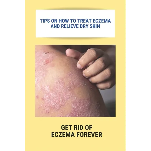 Tips On How To Treat Eczema And Relieve Dry Skin: Get Rid Of Eczema Forever: Overcome Eczema - Paperback