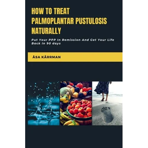 How To Treat Palmoplantar Pustulosis Naturally: Put Your PPP In Remission And Get Your Life Back In 90 Days - Paperback