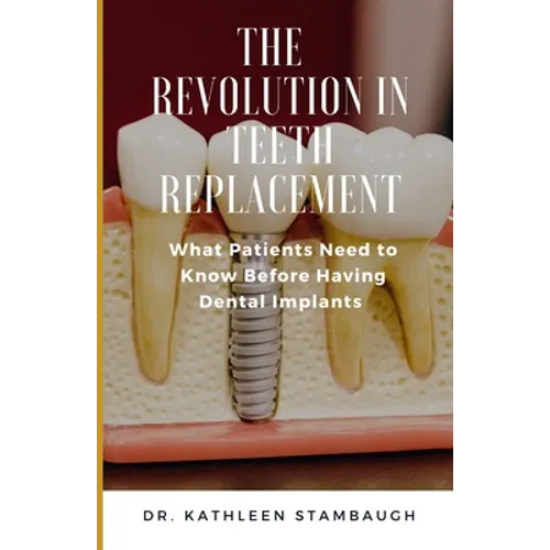 The Revolution in Teeth Replacement: What Patients Need to Know Before Having Dental Implants - Paperback