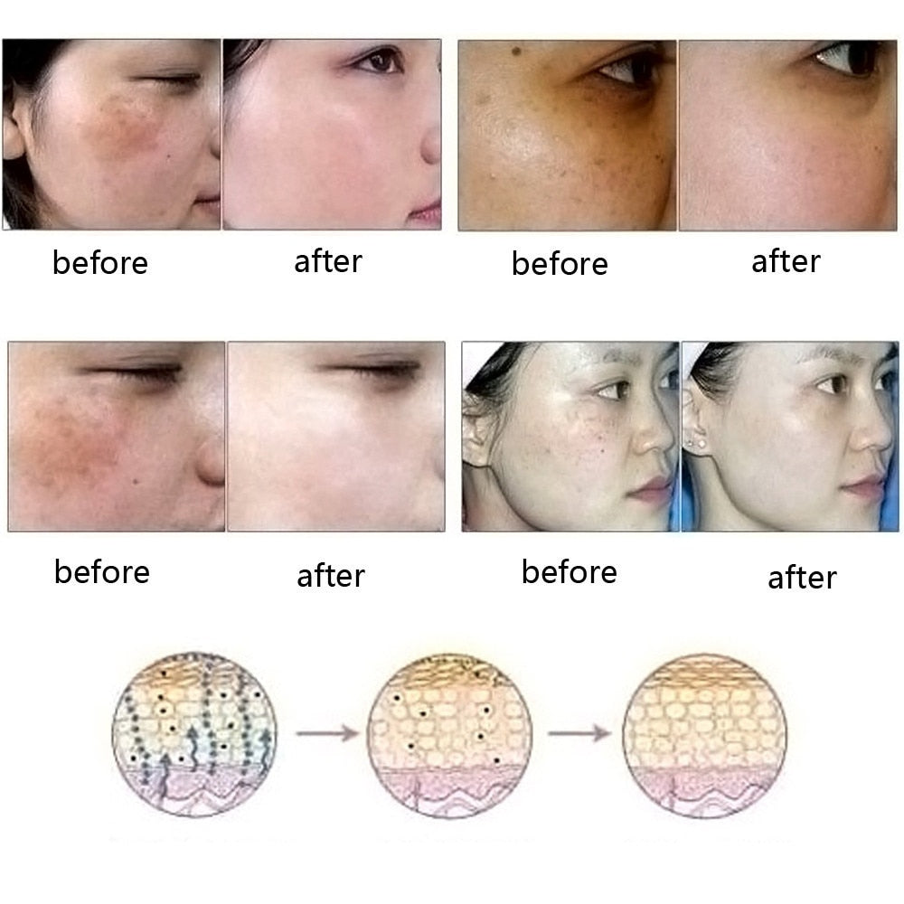 Dredge Meridian Skin Care Natural Pure Removal Acne Stretch Marks Scar Remova