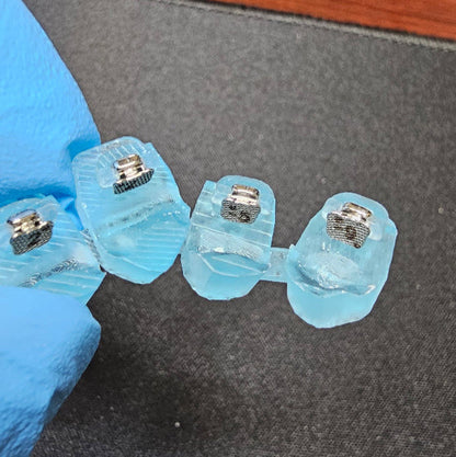 Custom Braces - as easy as clear aligners!