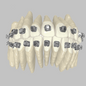 Custom Braces - as easy as clear aligners!
