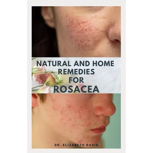 Natural and Home Remedies for Rosacea: A Self Help Guide To Completely Prevent and Treat Rosacea - Paperback