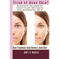 TIRED OF ACNE SKIN? Discover the Powerful Secrets to get Clearer Skin Permanently - Paperback