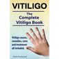 Vitiligo. Vitiligo causes, remedies, costs and treatment all included. The complete Vitiligo Book. - Paperback