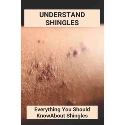 Understand Shingles: Everything You Should Know About Shingles: Shingles Topical Treatment - Paperback