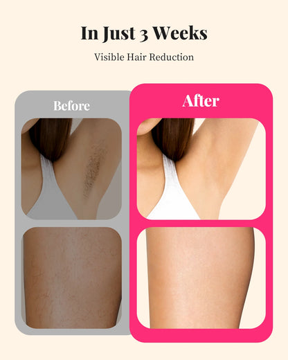IPL Hair Removal Device – 990,000 Flashes, 9 Energy Levels, Painless Permanent Hair Removal for Women & Men, Face, Body & Bikini, US/EU/UK Plug