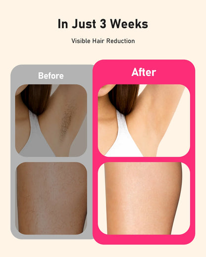JOOYEE AI06 IPL Hair Removal Device – 999,999+ Flashes, 9 Energy Levels, Permanent At-Home Hair Remover for Face & Body, Women & Men