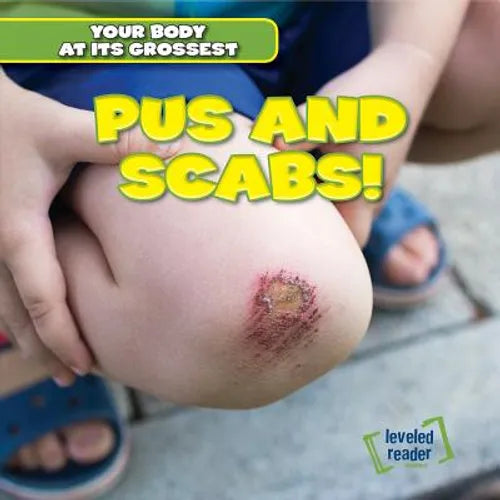 Pus and Scabs! - Library Binding
