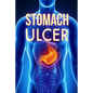 Stomach Ulcer: Treatment in 60 days!: Stomach Ulcer treatment - Paperback