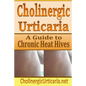 Cholinergic Urticaria: A Guide to Chronic Heat Hives - Paperback