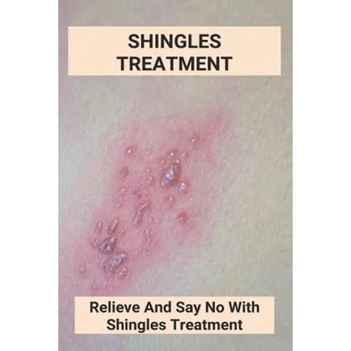 Shingles Treatment: Relieve And Say No With Shingles Treatment: Shingles On Face Treatment - Paperback