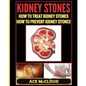 Kidney Stones: How To Treat Kidney Stones: How To Prevent Kidney Stones - Paperback