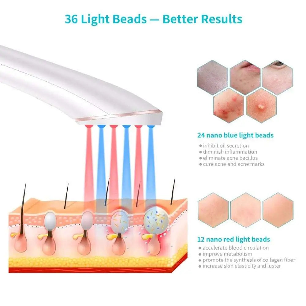 Xpreen Wireless Blue Light Acne Therapy Device